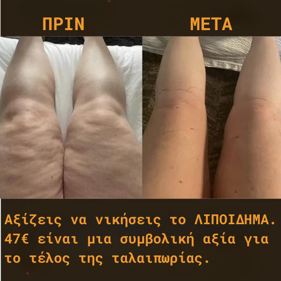 LipoEase™ — Φυσική Ρουτίνα Ανακούφισης για Λιποίδημα
