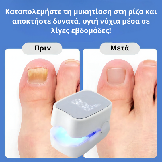 Prevazen™ - Λέιζερ για Μυκητίαση Νυχιών