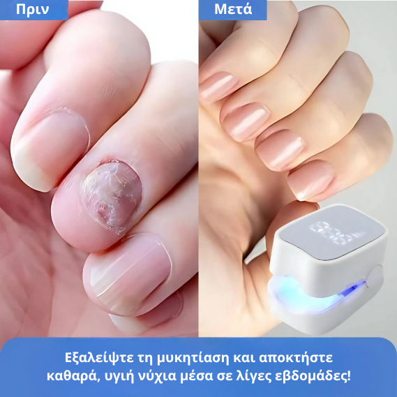 Prevazen™ - Λέιζερ για Μυκητίαση Νυχιών
